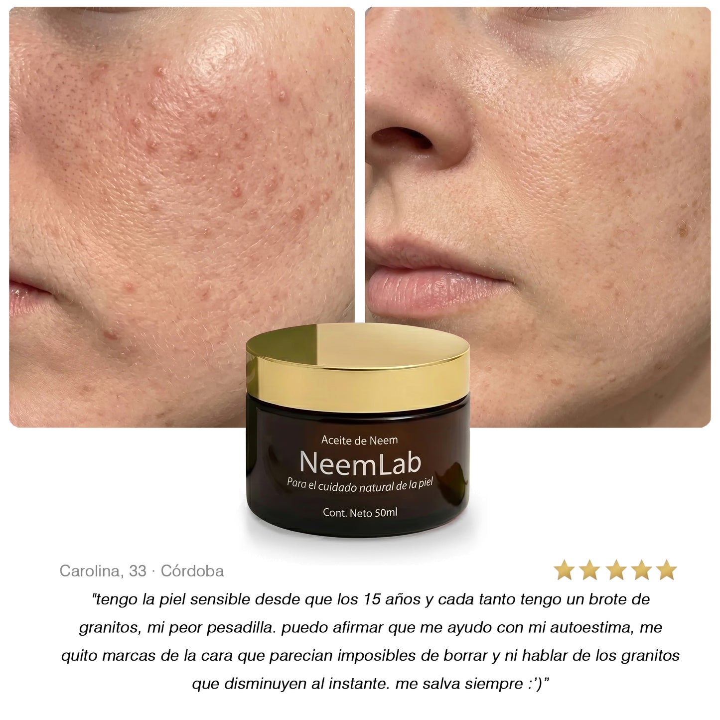 Neem Purificante I Aceite natural contra acné y piel grasa