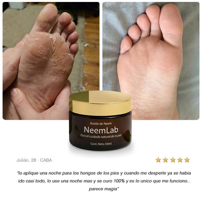 Neem Antifungi I Aceite natural contra hongos y pie de atleta