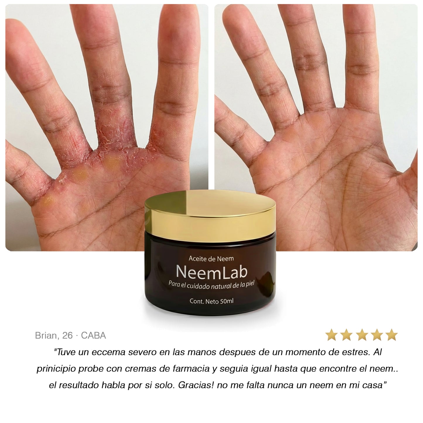 Neem Calmante I Aceite natural contra eccema y piel irritada