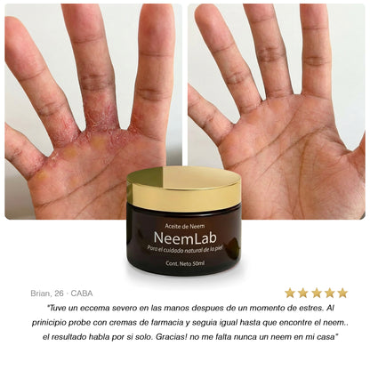 Neem Calmante I Aceite natural contra eccema y piel irritada